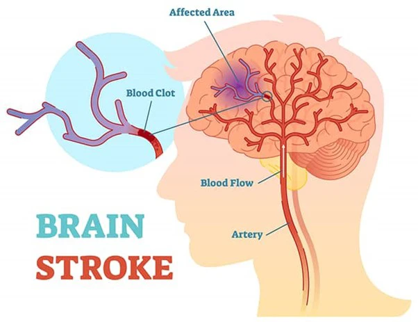 Chiropractic Nelson Tasman Stroke Diagram